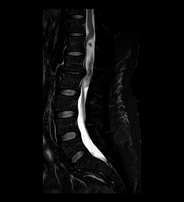 Myxopapillary Ependymoma Image Radiopaedia Org