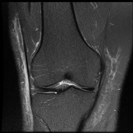 Medial discoid meniscus | Image | Radiopaedia.org