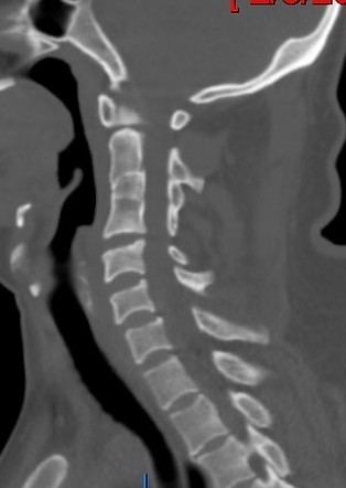 C7 laminar fracture and Klippel-Feil syndrome | Radiology Case ...