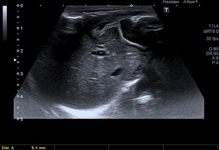 Congenital Hypertrophic Pyloric Stenosis Radiology Case Radiopaedia Org