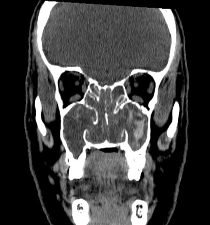 Allergic fungal sinusitis | Radiology Reference Article | Radiopaedia.org