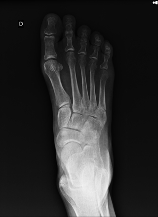 Jones fracture | Radiology Case | Radiopaedia.org