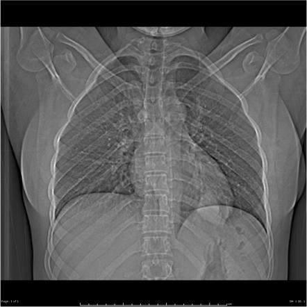 Pulmonary Hydatid Cyst | Radiology Case | Radiopaedia.org