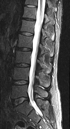 Osteoid osteoma - T12 vertebra | Image | Radiopaedia.org