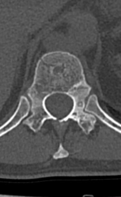 osteoma osteoide columna vertebral