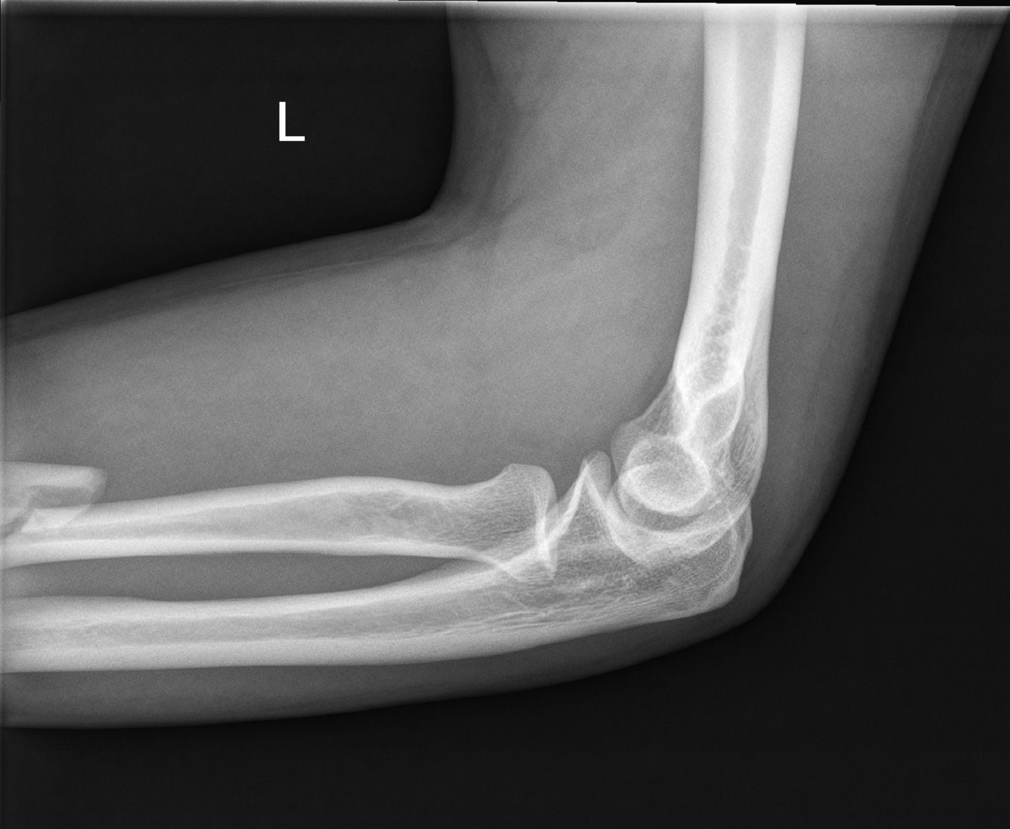 Displaced radial shaft fracture with radial head dislocation | Image ...