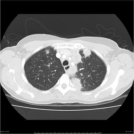 Multiple pulmonary nodules >5 mm (differential diagnosis) | Radiology ...