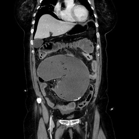 Obstructive distal colonic adenocarcinoma causing cecal perforation ...