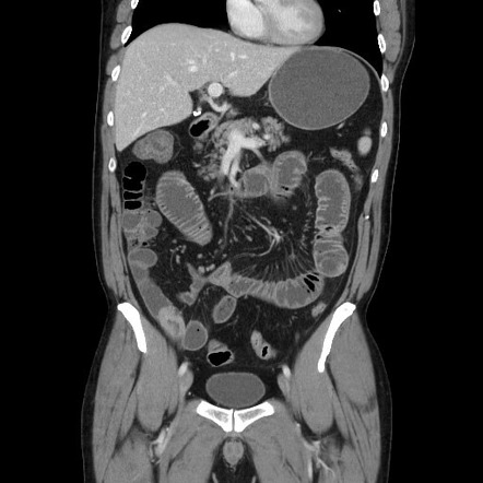 Malignant small bowel obstruction due to lymphoma | Radiology Case ...