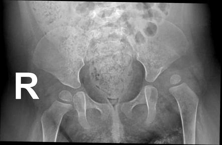 case study developmental dysplasia of hip