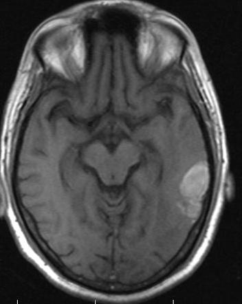 Cerebral venous infarction | Radiology Case | Radiopaedia.org