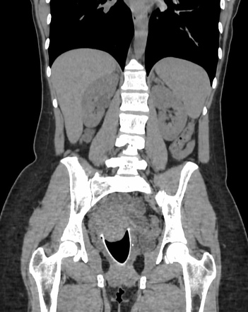 Menstrual cup (CT) | Image | Radiopaedia.org