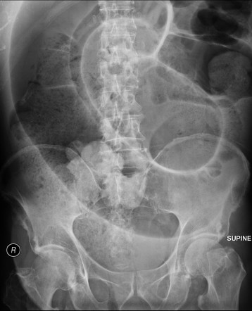 Sigmoid volvulus | Radiology Case | Radiopaedia.org