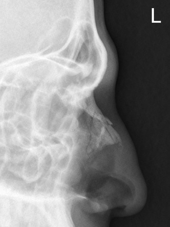 Nasal bone fracture | Radiology Reference Article | Radiopaedia.org