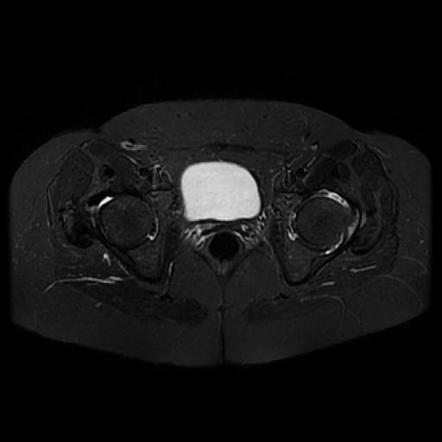 Synovial osteochondromatosis - hip | Image | Radiopaedia.org