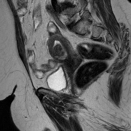 Submucosal uterine leiomyoma | Radiology Reference Article ...