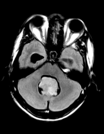 Posterior fossa ependymoma | Image | Radiopaedia.org