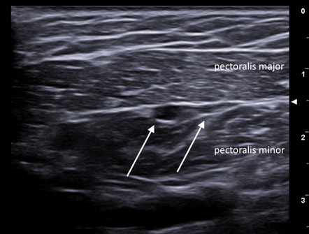 Interpectoral lymph node | Radiology Reference Article | Radiopaedia.org