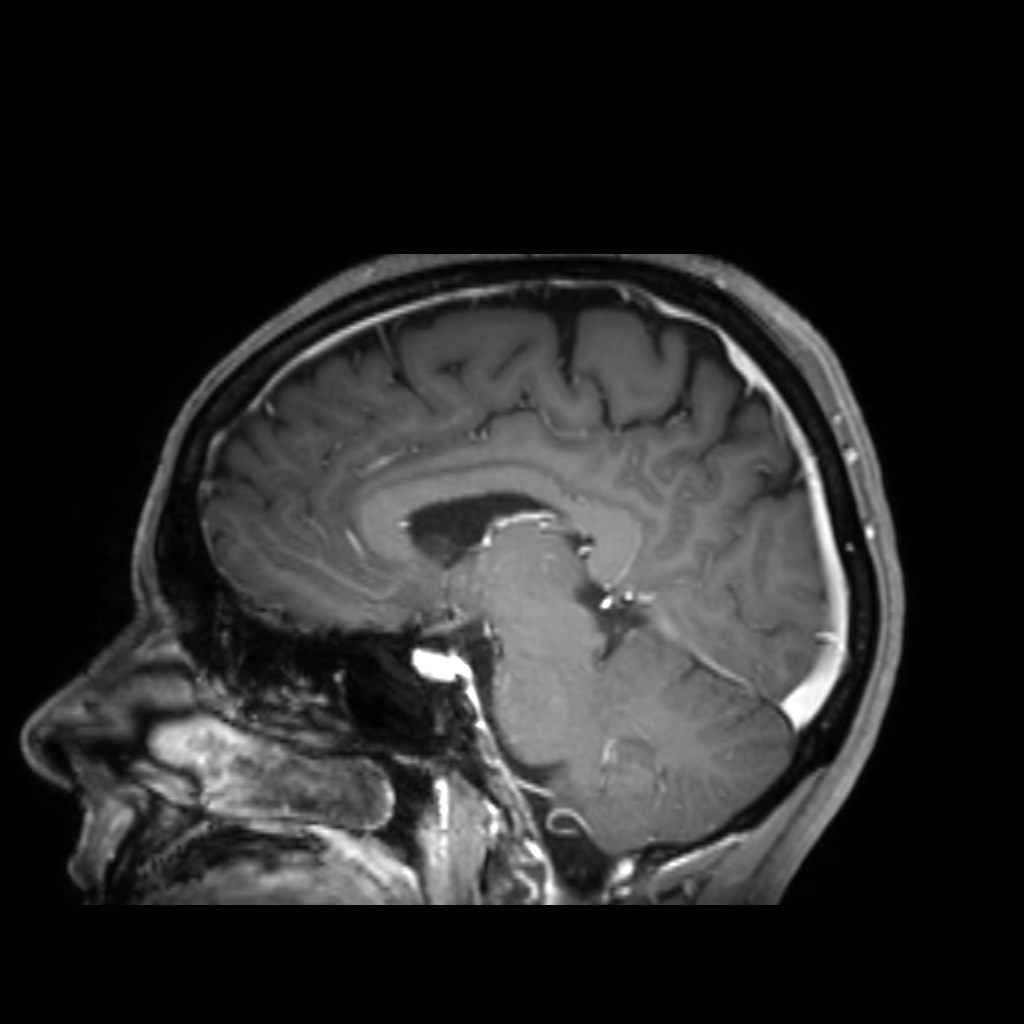 Developmental venous anomaly - atypical | Image | Radiopaedia.org