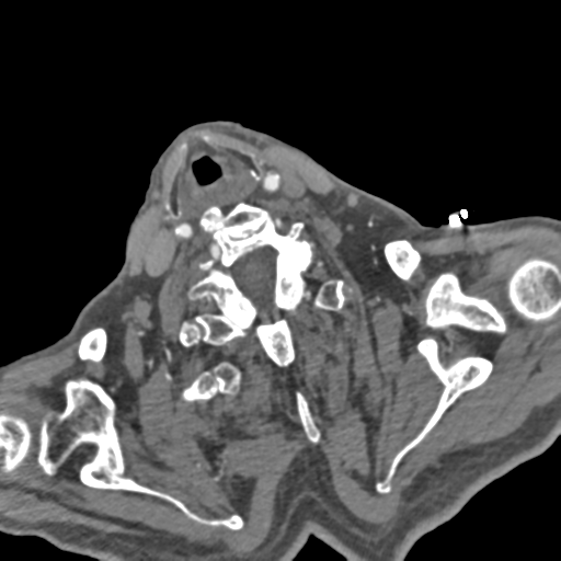 Mca Stroke With Calcified Embolism And Movement On Perfusion Image