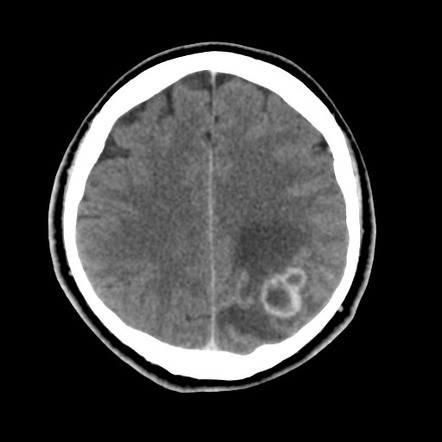 Cerebral abscess | Image | Radiopaedia.org