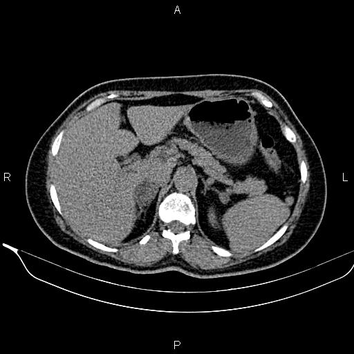 Bilateral benign adrenal adenomas | Image | Radiopaedia.org