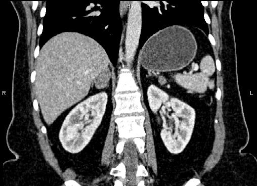 Bilateral Benign Adrenal Adenomas Image 6365