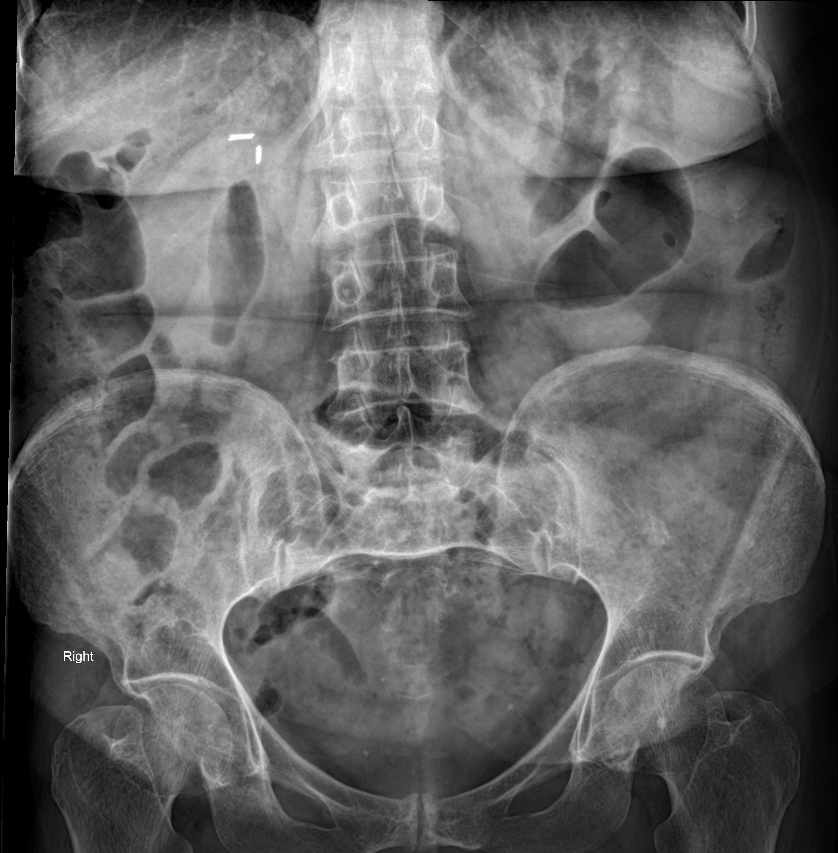 Dolichocolon and transverse colon ptosis | Image | Radiopaedia.org