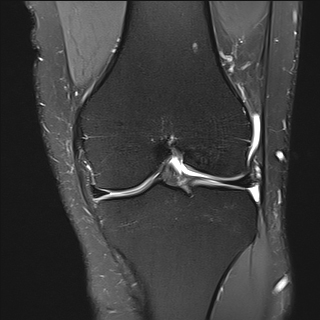 Longitudinal interstitial tear of patellar tendon | Image | Radiopaedia.org