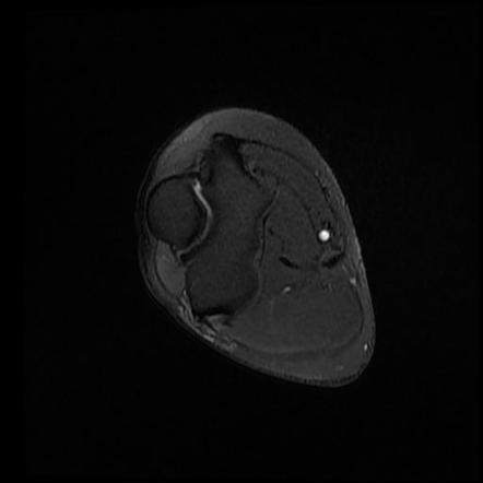 Lateral epicondylitis | Radiology Case | Radiopaedia.org