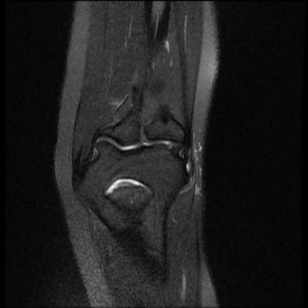 Lateral epicondylitis | Radiology Reference Article | Radiopaedia.org