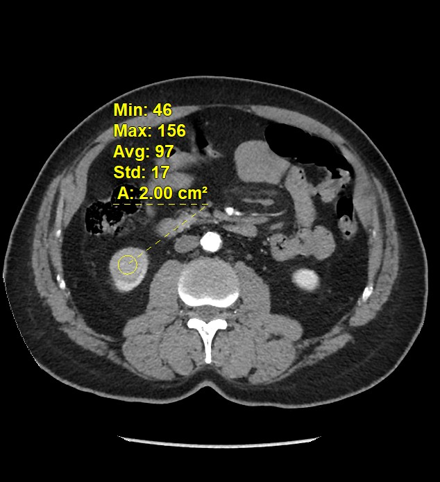 Chromophobe Renal Cell Carcinoma Image Radiopaedia Org