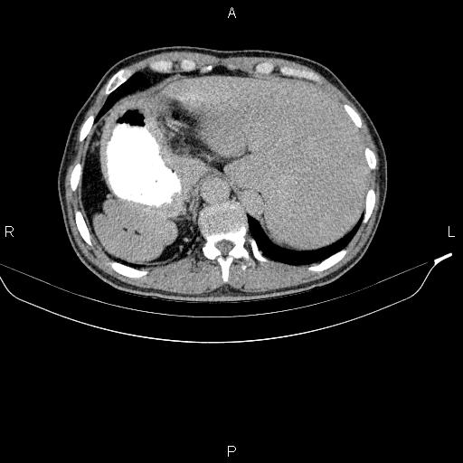 Gastric cancer in a patient with situs inversus | Image | Radiopaedia.org