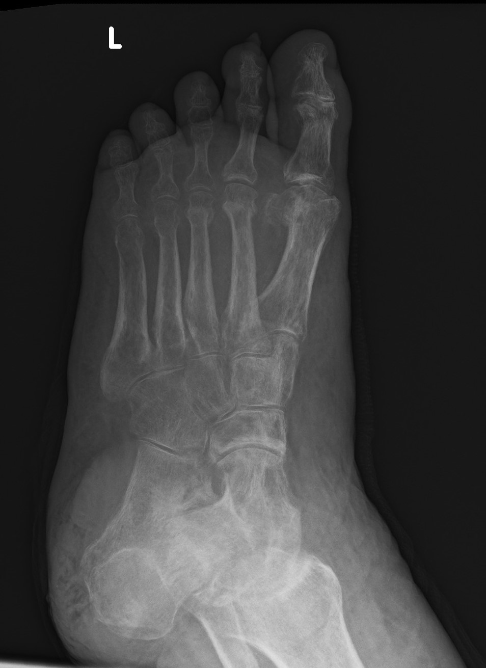 Calcaneal osteomyelitis: speed of destruction | Image | Radiopaedia.org