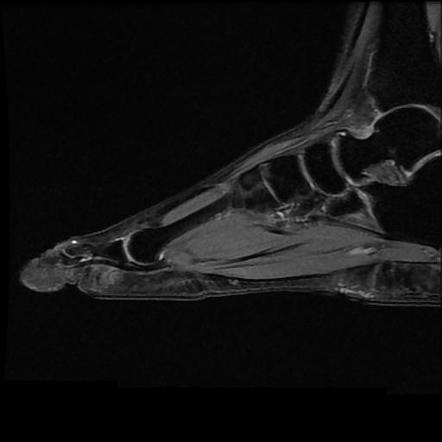 Rupture Of The Extensor Hallucis Longus Tendon Image Radiopaedia Org