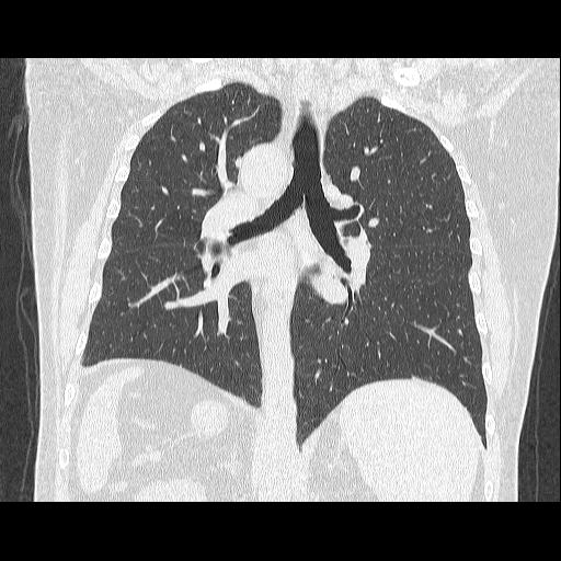 Situs inversus | Image | Radiopaedia.org