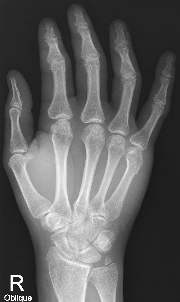 Persistant ulnar styloid ossicle | Image | Radiopaedia.org