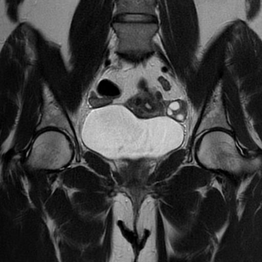 Pedunculated subserosal uterine leiomyoma | Image | Radiopaedia.org