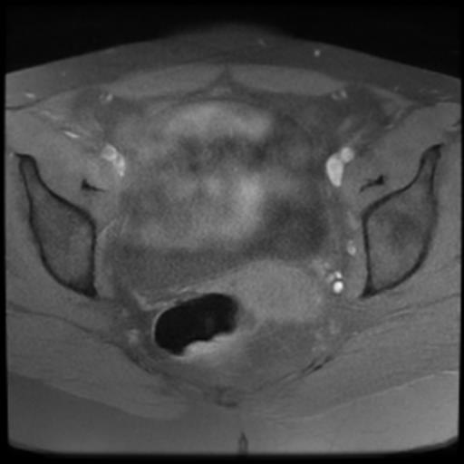 Pedunculated Subserosal Uterine Leiomyoma Image