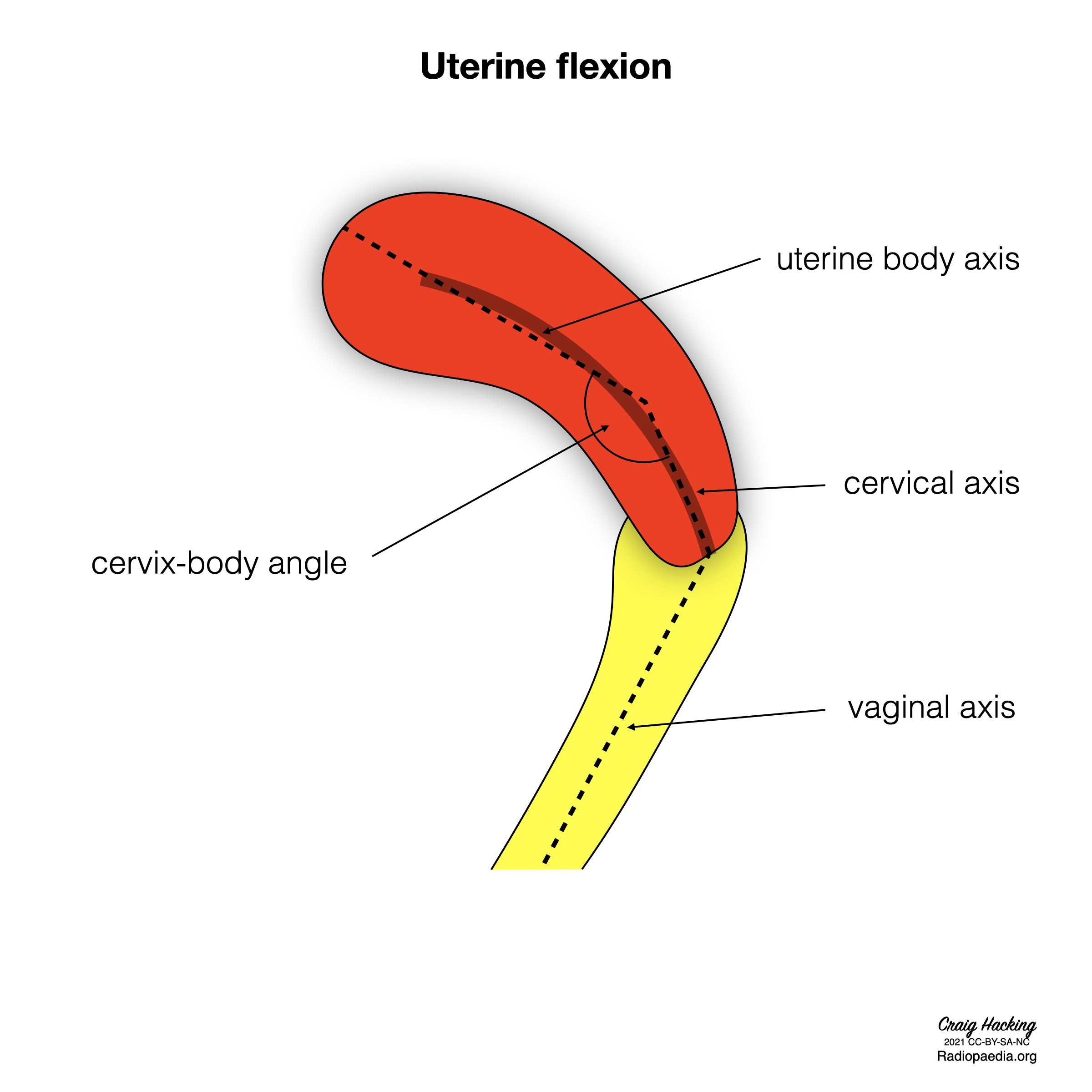 Uterine version and flexion (diagrams) | Image | Radiopaedia.org