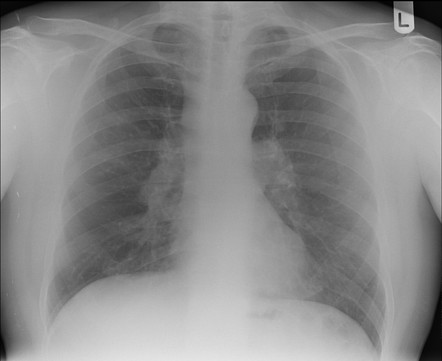 Sarcoidosis | Radiology Case | Radiopaedia.org