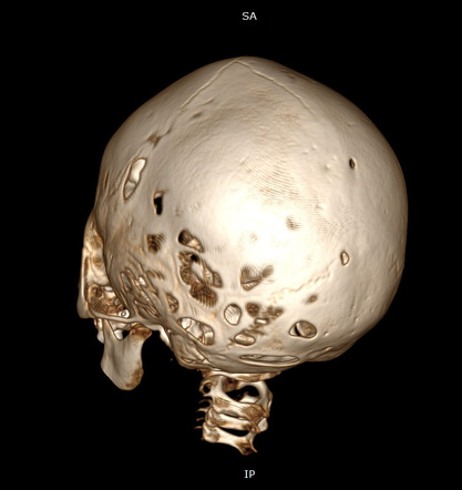 Hypophosphatasia | Radiology Reference Article | Radiopaedia.org