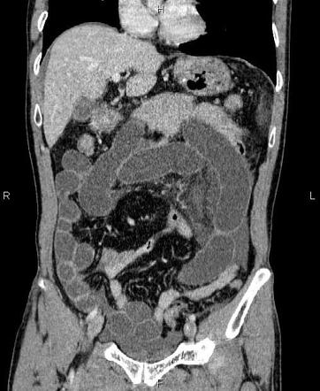 Closed loop obstruction | Image | Radiopaedia.org