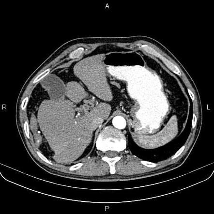 Cavernous transformation of the portal vein | Image | Radiopaedia.org