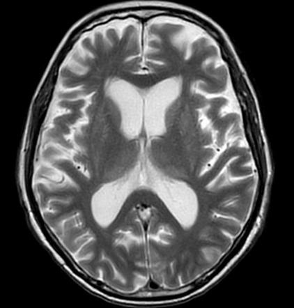 Pulvinar sign in status epilepticus | Radiology Case | Radiopaedia.org