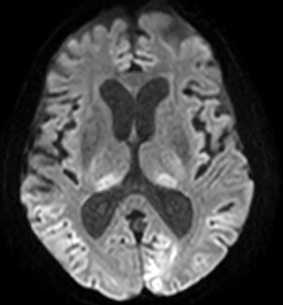 Pulvinar sign (CNS) | Radiology Reference Article | Radiopaedia.org