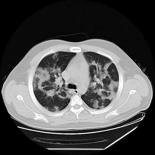 Pulmonary target sign | Radiology Reference Article | Radiopaedia.org