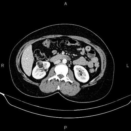 Renal angiomyolipoma | Radiology Case | Radiopaedia.org