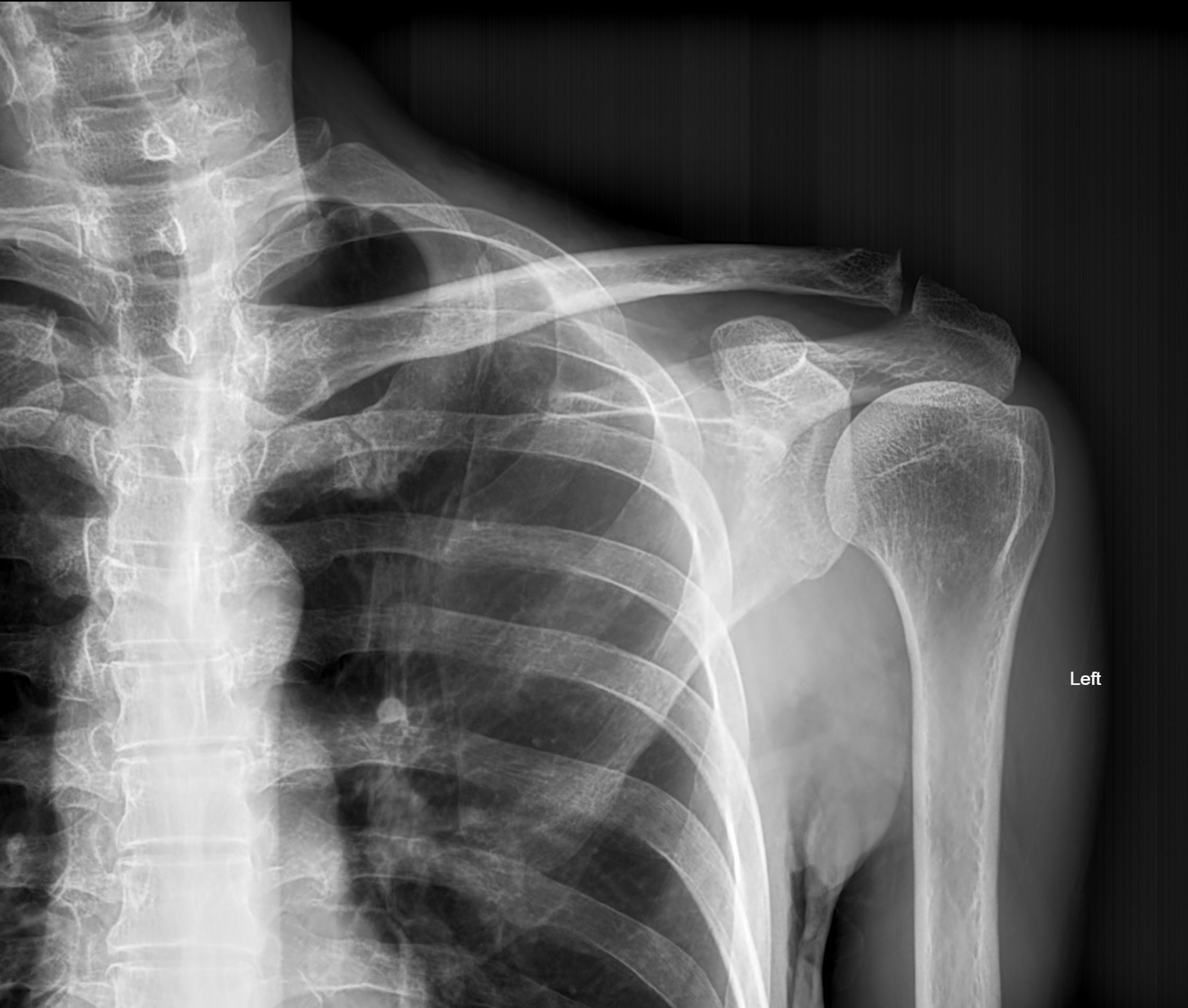 Sprengel deformity | Image | Radiopaedia.org