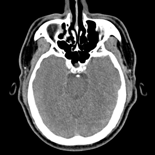 Isolated Primary Intraventricular Hemorrhage | Image | Radiopaedia.org